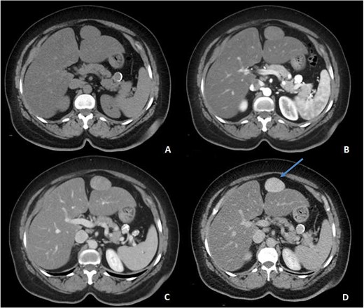 Pre-contrast (A), Arterial (B), Porto-venous (C) and Delayed (D) images of contrast enhanced CT demonstrating a well-defined, homogeneous, progressively enhancing mass anterior to the left hepatic lobe, with homogeneous delayed images (blue arrow). Incidental hepatic steatosis and a small splenic artery aneurysm are present.
