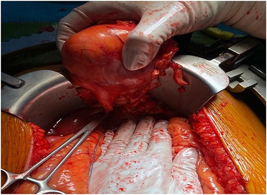 Macroscopic view of the tumor prior to resection.