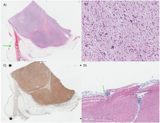 (A) Low magnification: there is a highly cellular process despite being well-circumscribed from the surrounding adipose tissue and vascular structures (arrow). (B) Higher magnification: The tumor is composed of highly atypical cells, some with bizarre dark nuclei, in a bluish hue (myxoid stroma). (C) The tumor has only a strong tumor positivity for the CD34, CD99 and Vimentin (mesenchymal markers), indicative of a sarcoma process (CD34 in this image). (D) For the histopathology report, as there’s a debate for chemotherapy role in soft tissue sarcoma, the size (larger than 5 cm—our case is 6.0 cm), grade (Grade 3—our case is high-grade), margin (arrow) and location as considered determinants for adjuvant chemotherapy.