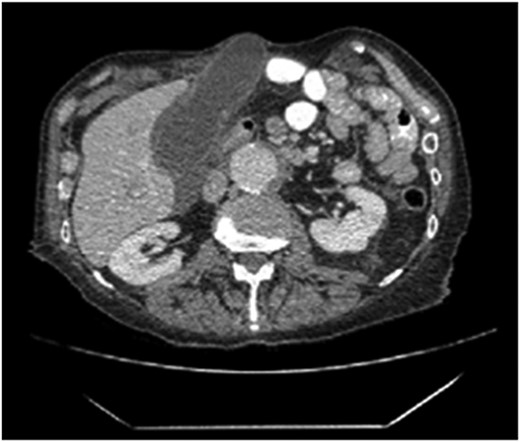 The axial section of the abdomen/pelvis CT scan illustrating our patient’s incisional hernia containing his gallbladder.