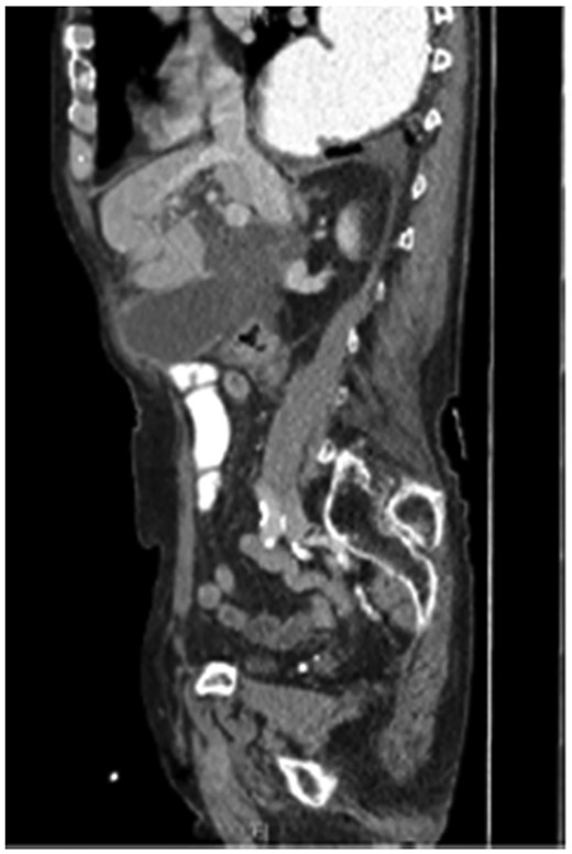 The coronal section of the abdomen/pelvis CT scan illustrating our patient’s incisional hernia containing his gallbladder.