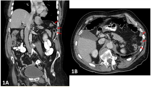 (A and B) Pre-operative CT abdomen (A—coronal, B—transverse planes) with multiple peritoneal nodules indicated by the arrows.
