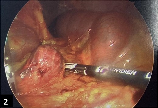 Intra-operative imaging of bleeding omental splenosis nodule.