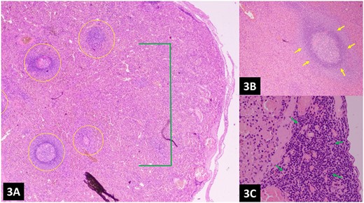 (A–C) Histopathology of the omental nodules reveals normal splenic tissue; the spleen can be recognized by red pulp (network of splenic cords and sinusoids filled with blood) and white pulp (lymphoid tissue usually surrounding splenic blood vessels), indicated by green and yellow arrows, respectively.