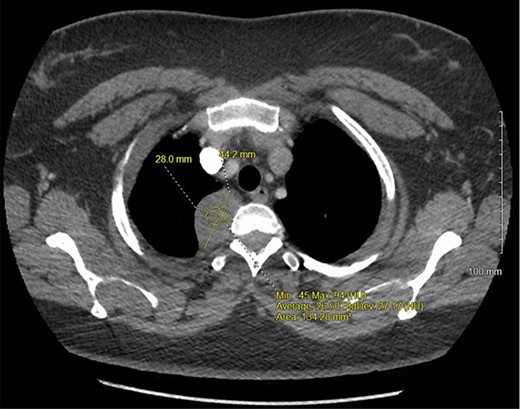 CT chest with IV contrast transverse view with detailed measurements of right T2-T3 paravertebral mass.