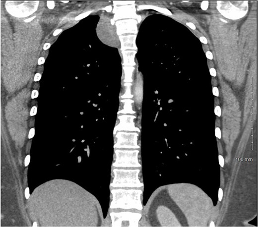 CT chest with IV contrast coronal view of right T2-T3 paravertebral mass.
