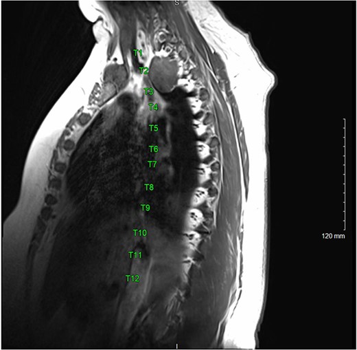 T1 MRI sagittal view of T2-T3 right paravertebral mass.