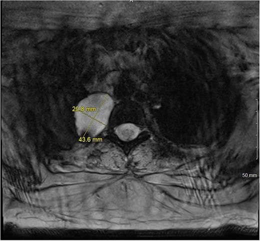 T2 MRI transverse view of T2-T3 paravertebral mass.