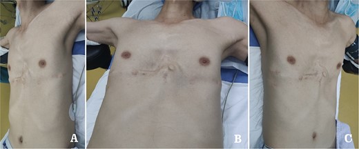 Appearance of chest wall before operation. (A) Left side view; (B) front view; and (C) right side view.