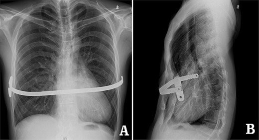 X-ray examination before operation. (A) Posteroanterior radiograph; and (B) lateral radiograph.
