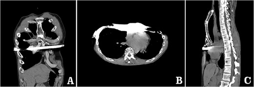 Computed tomography examination before operation. (A) Coronal view; (B) sectional view; and (C) sagittal view.