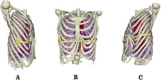 Preoperative 3D reconstruction pictures. (A) Right side view; (B) front view; and (C) left side view.