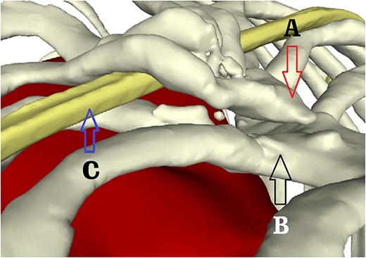 Partial view of the lower sternum. (A) End of the severed sternum; (B) lower end of sternal body and (C) steel bar of the first operation.