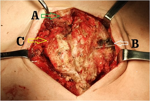 Operative field through the median incision. (A) Lower end of sternal body; (B) steel bar of the first operation and (C) end of sternum and rib arch supported by the steel bar.