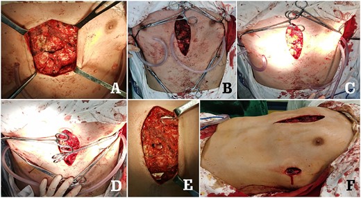 Surgical pictures. (A) The anterior chest wall structures; (B) and (C) Wung procedure was performed; (D) Wenlin procedure was performed; (E) median operative field after Wung procedure and Wenlin procedure and (F) appearance of chest wall before incisions sutured.
