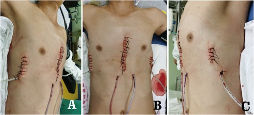 Postoperative appearance of chest wall. (A) Right side view; (B) front view and (C) left side view.