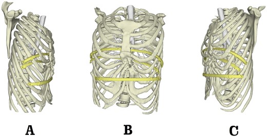 Postoperative 3D reconstruction pictures. (A) Right side view; (B) front view and (C) left side view.