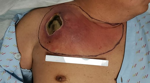 Right chest wall abscess with overlying eschar from extravasation injury due to calcium gluconate infusion via right internal jugular vein central catheter.