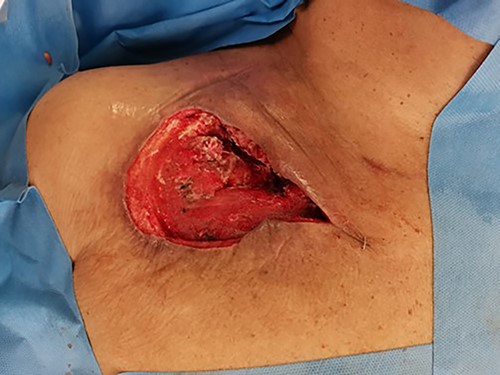 Intra-operative picture post second debridement.