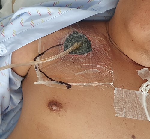 Post application of negative pressure dressing (after debridement).