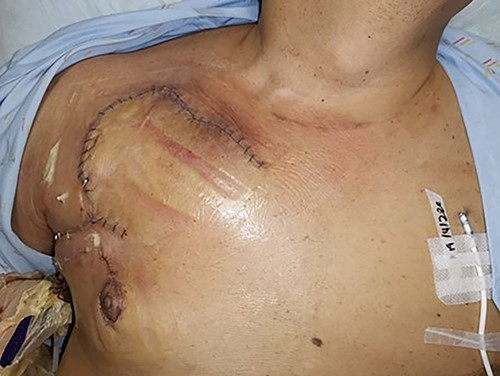 Post single stage right pectoralis major turnover flap, rhomboid skin flap, and inferior nipple transposition.