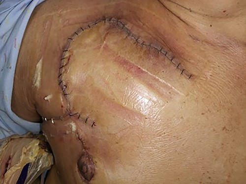 Close-up post single stage right pectoralis major turnover flap, rhomboid skin flap, and inferior nipple transposition.