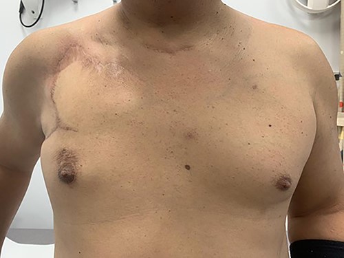 9 months post-operatively (anterior view).