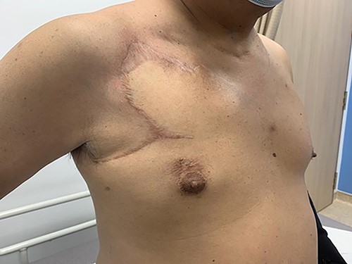 9 months post-operatively (anterolateral view).