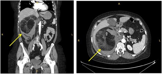 Coronal (a) and transverse (b) sections of initial CT imaging with contrast showing large lesion with heterogeneous hypodense areas with surrounding haematoma (arrowed).