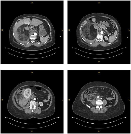 Sequential transverse sections of CTAP in arterial phase showing extent of lesion down to level of right Ilium bone.