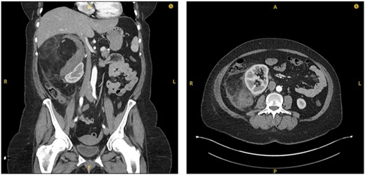 Interval CT imaging showing decrease in size of lesion and surrounding haematoma.