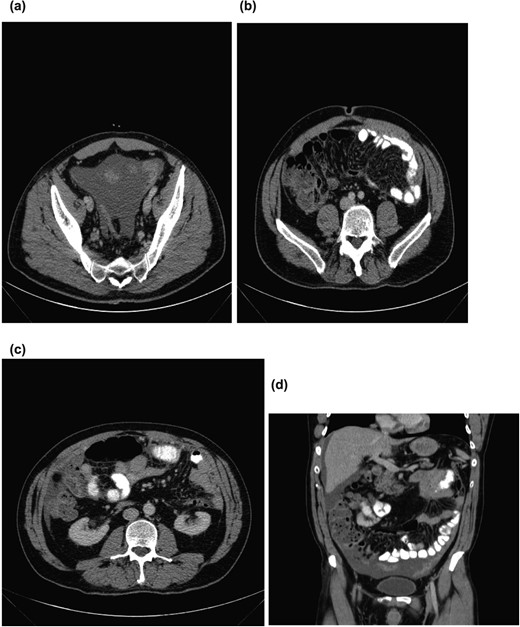 (a) Pelvic ascites. (b) Axial section showing omental caking. (c) Axial section showing omental caking. (d) Sagittal section showing peritoneal nodularity and ascites.