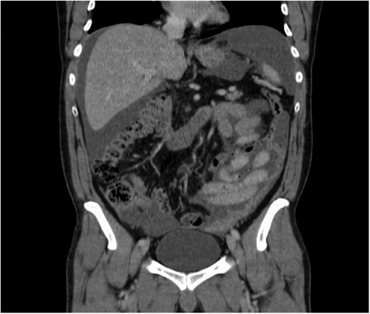 Increase in the amount of ascites post-ultrasound-guided biopsy.