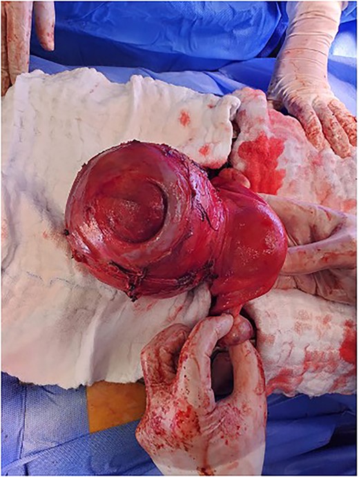 The cervical myoma attached to the uterus with intact infundibulopelvic ligament.