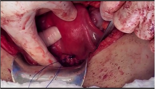 The cerclage placement after suturing the uterine isthmus to the vagina.