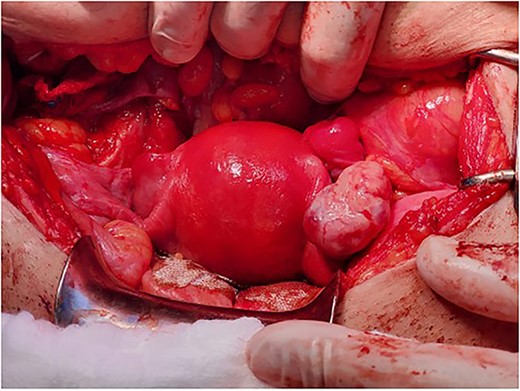The final appearance of the uterus and ovaries.
