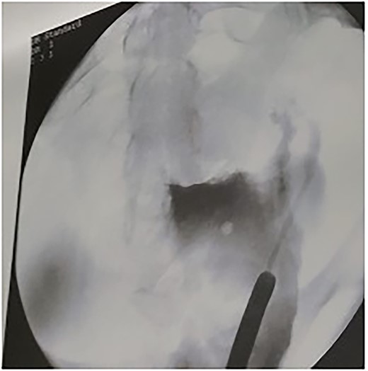 Leakage of contrast through the fistula.