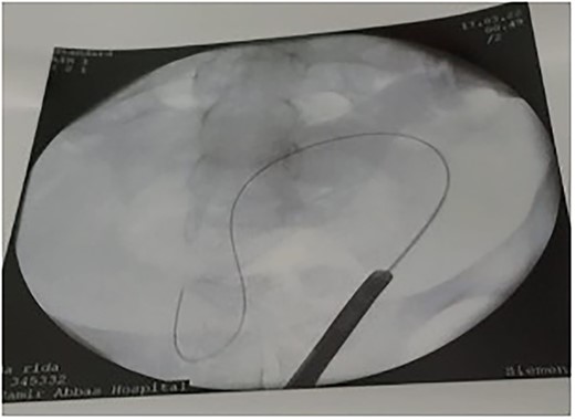 Guide wire passed through the UV fistula.