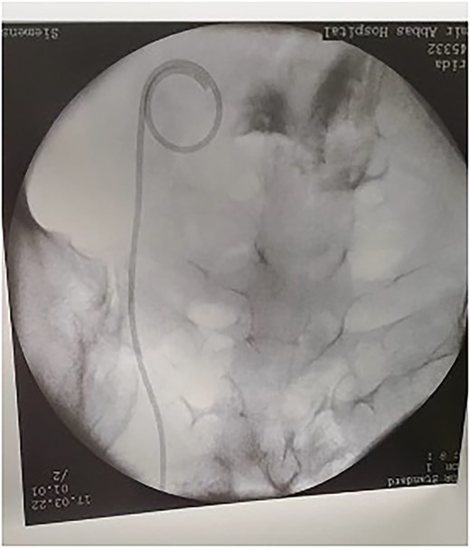 After insertion of DJ stent.