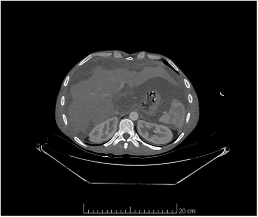 Computed tomography scan of the abdomen and pelvis showed massive amount of free abdominal fluid and irregular margins of the liver.