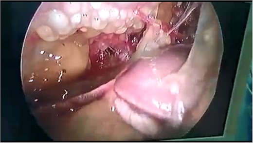 Abdominal laparoscopy showed a huge amount of mucus gelatinous fluid.