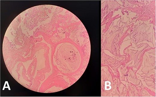 Biopsies from (A) peritoneum and (B) omentum showed acellular mucin consistent with PMP. No mucinous, degenerative or tumor cells are seen.