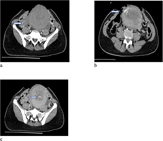 CT scan of the pelvis (a-c) after cesarean section revealed focus of contrast blush seen in the arterial phase at the right lateral side of the uterine wall, which increased in the venous and delayed phases suggesting active arterial bleeding. The contrast extravasation is also seen within the endometrial cavity.