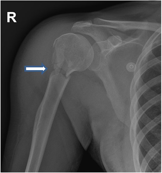 Upper limb X-ray revealed fracture of right Humerus.
