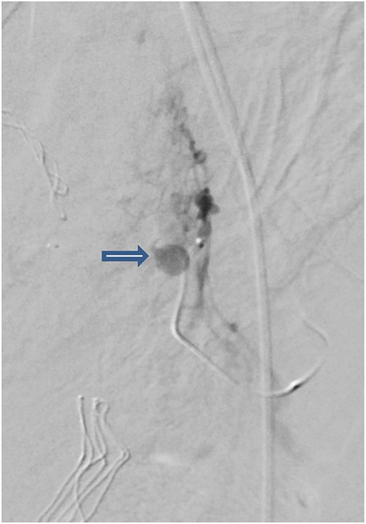 Pelvic angiogram revealed a pseudoaneurysm (see arrow) measuring ~7 mm arising from the branches of the left uterine artery.