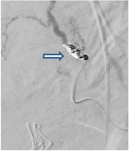 Post embolization angiogram showed satisfactory results after multiple Vortex coils were used to obliterate of feeding vessels.