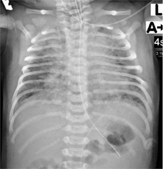 Chest X-ray of the neonate showed diffuse patchy pulmonary infiltrations.