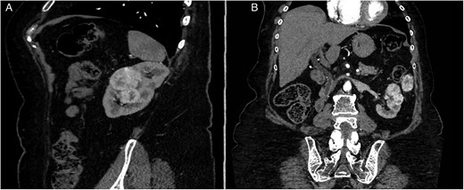 Preoperative CT-scan. (A) Sagittal section. (B) Modified coronal section allowing to see the left pericolic gutter metastasis.