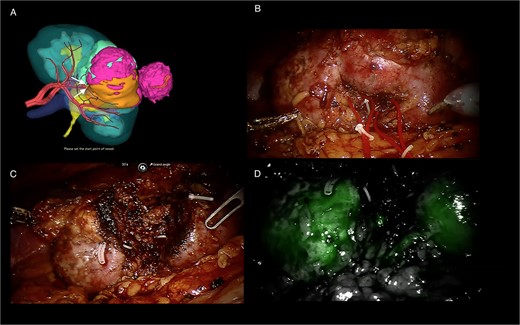 3D-model (FUJIFILM) of the tumoral kidney and per operative screenshots. (A) 3D-model (FUJIFILM) of the tumoral kidney with superselective clamping points. (B) Tumoral kidney before tumorectomy. (C) Kidney after tumorectomy. (D) Indocyanin green angiography after tumorectomy with homogeneous parenchyma coloration.