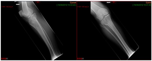 Plain radiograph AP and lateral.